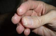 راه‌های پیشگیری از اگزما در ایام کرونا