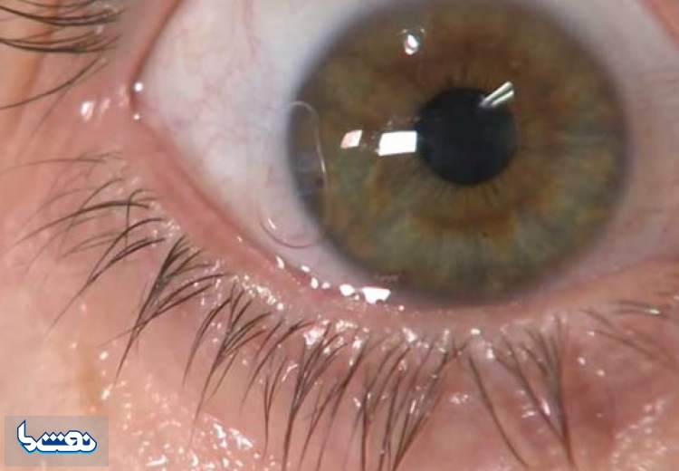 کدام تغییرات در چشم نشانه ابتلا به کروناست؟