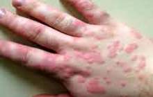 مهمترین علائم «پوستی» ابتلا به کرونا