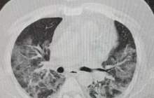 ریه فردی که به کرونا مبتلا شده چگونه است؟  <img src="/images/video_icon.png" width="16" height="16" border="0" align="top">